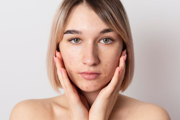 The Ultimate Skincare Routine for Acne